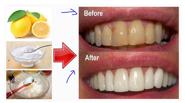 Begini 5 Cara Memutihkan Gigi Secara Alami